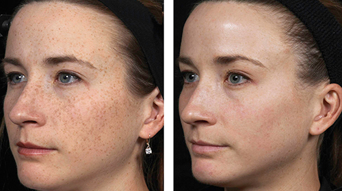 Pigmented Lesions, sun spots, age spots treatment in Burnaby BC.